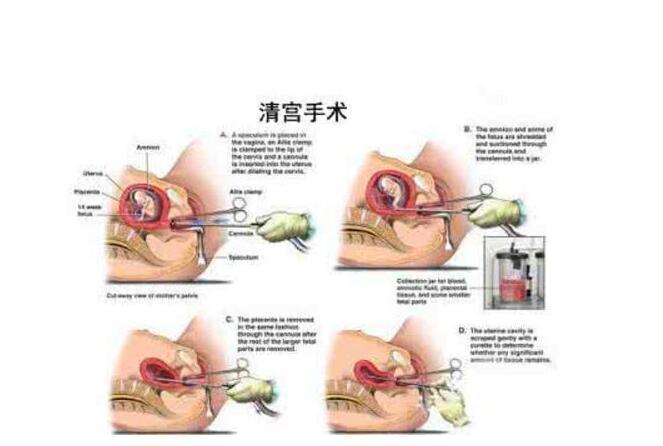 最新流产技术，守护女性健康之路