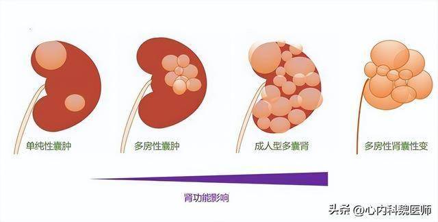 多囊肾最新药物研究进展与未来治疗前景展望