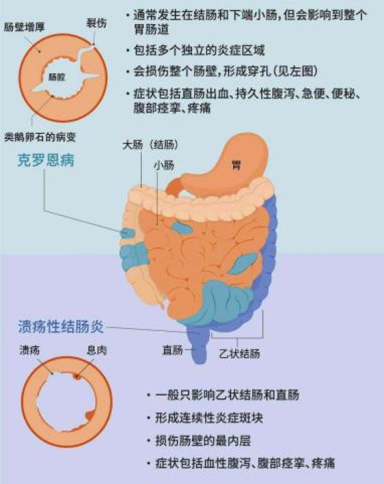 克罗恩最新疗法引领肠道疾病治疗新篇章