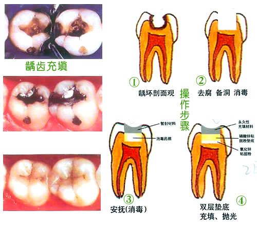 最新补牙技术，重塑牙齿健康的新里程碑