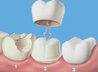 最新根管治疗技术，重塑牙齿健康的明日之光